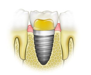 Implant crown adjacent teeth drawing