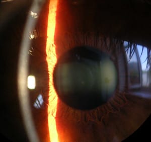 Slit lamp image of the cornea
