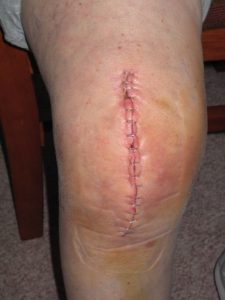 A Quick Guide on Types of Knee Surgeries