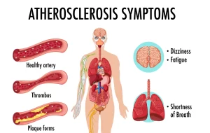 Understanding Atherosclerosis Symptoms: Recognizing the Warning Signs