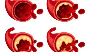 The Triggers of Thrombosis