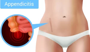 Recognizing Appendicitis Symptoms