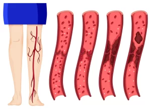 Understanding the Hidden Danger Of Deep Vein Thrombosis