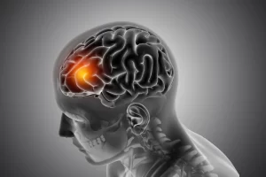 Understanding the Types of Brain Stroke: A Comprehensive Guide